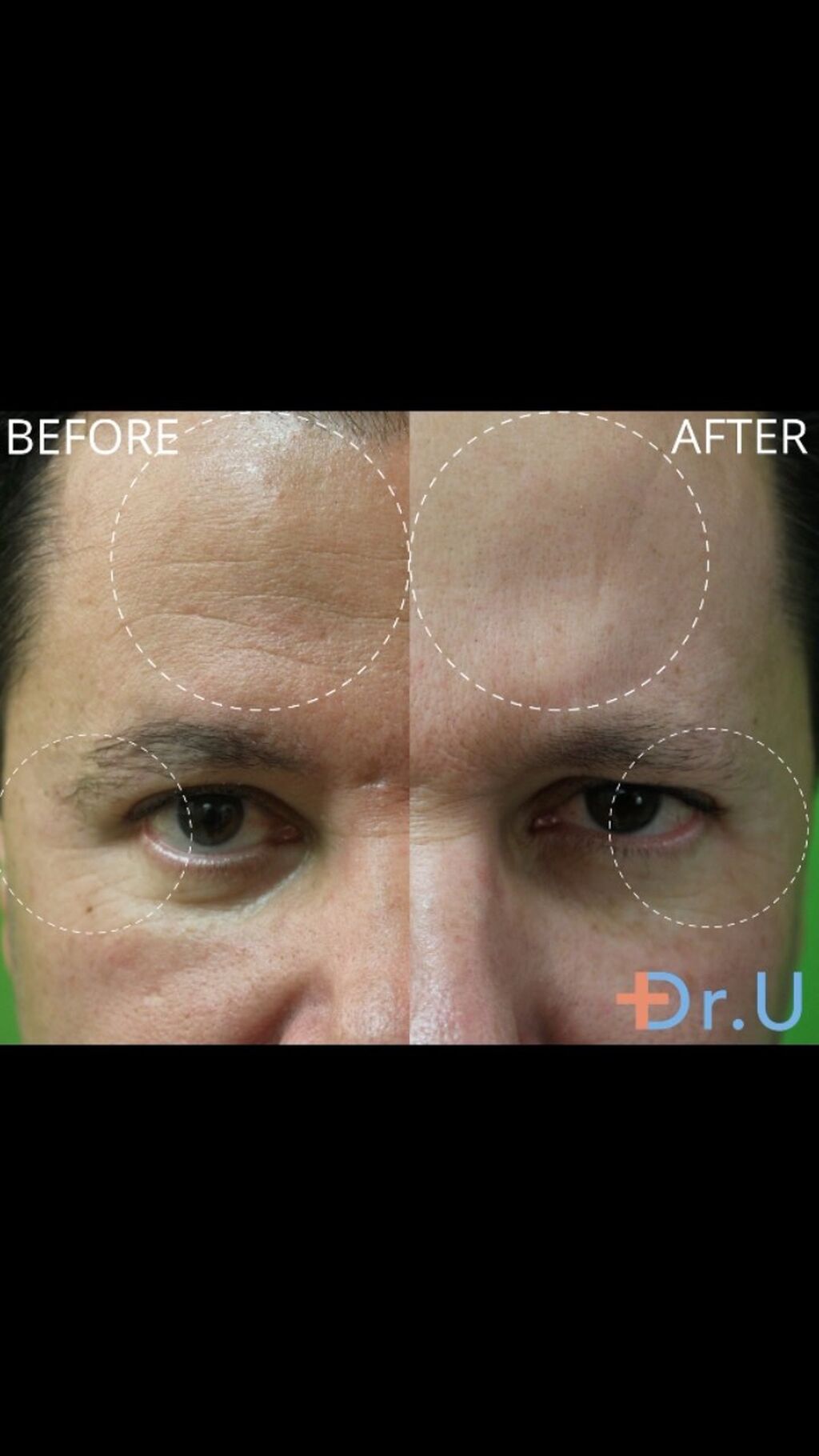 Frown Lines & Wrinkle Treatment