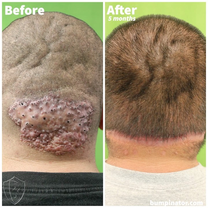 AKN Treatment - Dr. U Hair and Skin Clinic