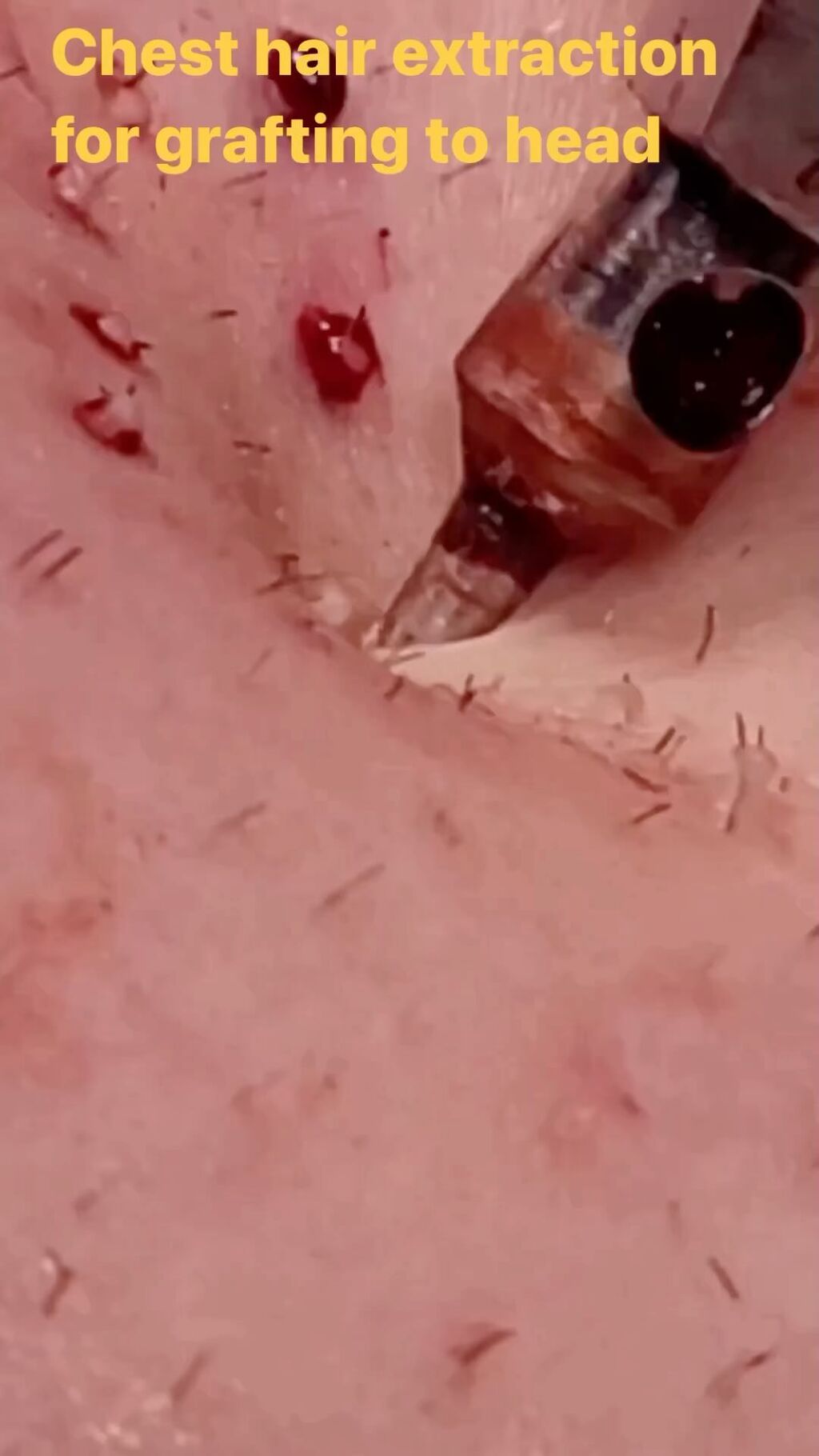 Dr. UGraft Body Hair Transplant Services