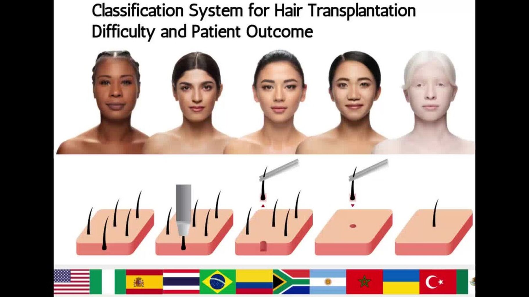 A New Universal Follicular Unit Excision Classification System for Hair Transplantation Difficulty and Patient Outcome