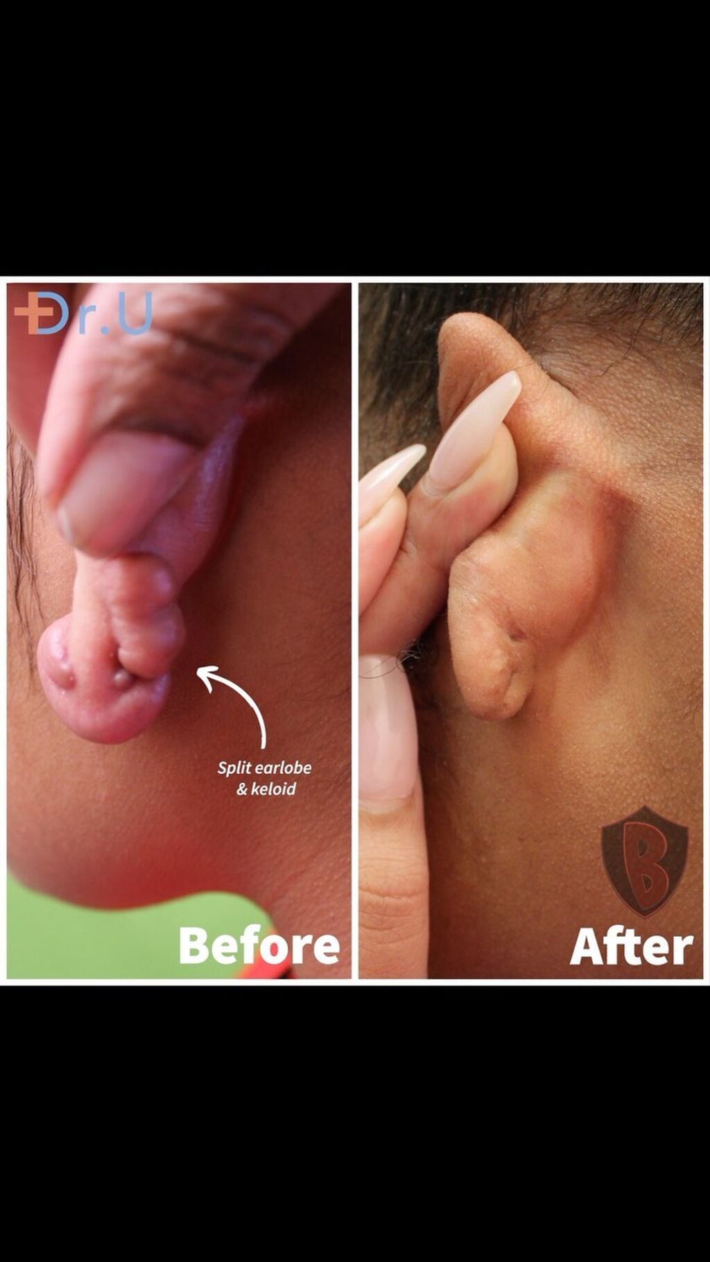 Resolving The Keloid Scar Dilemma