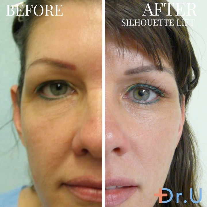 Non Surgical Jowl Lift in Los Angeles