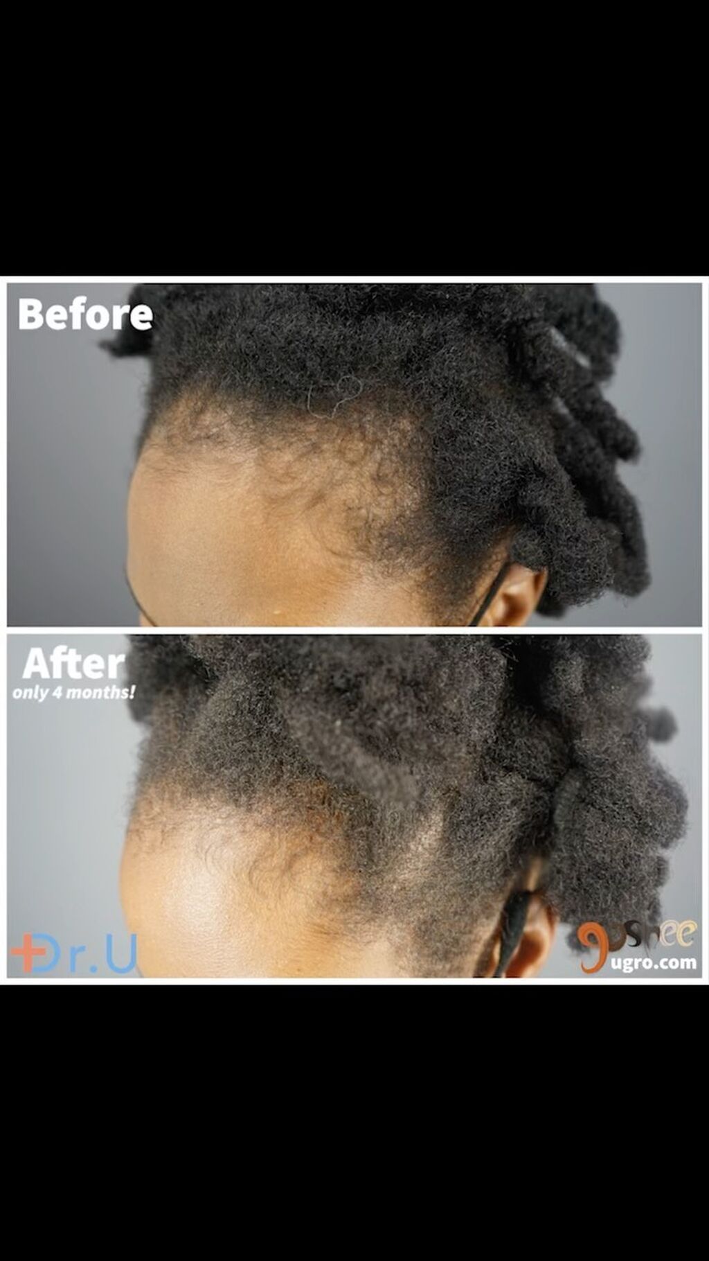 GASHEE Hair Stories: Amazing 4-Month Natural Hair Growth Results