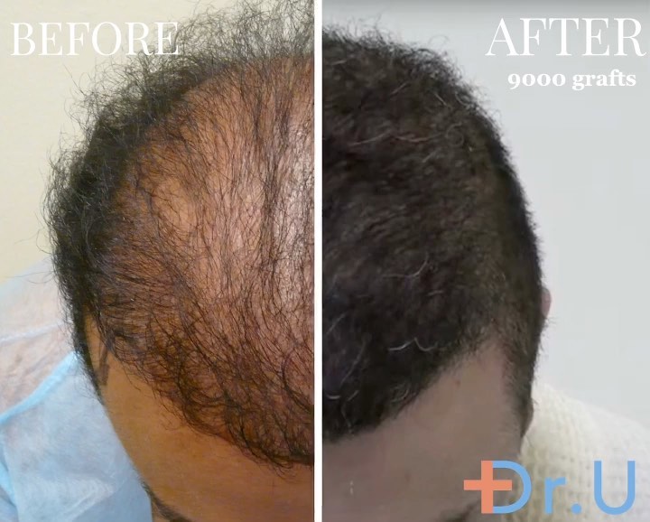 Dr. UGraft Hair Transplant Repair Services