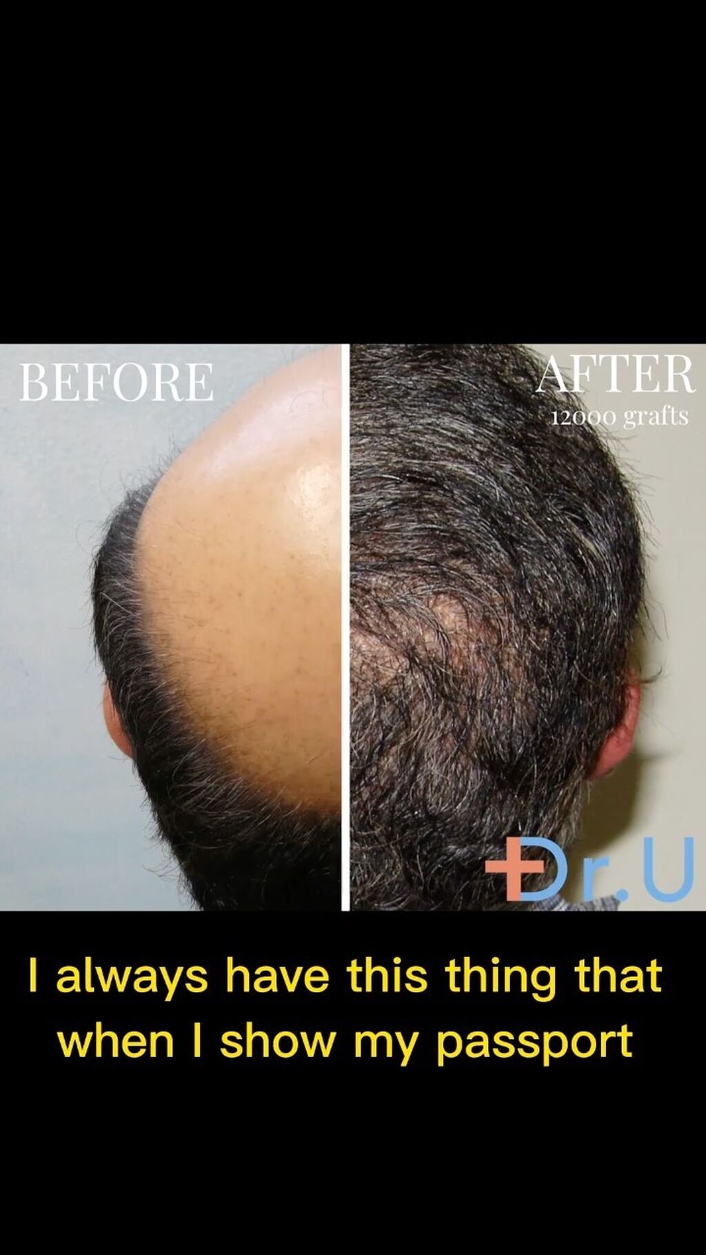 What is the Dr. UGraft Advanced FUE System?