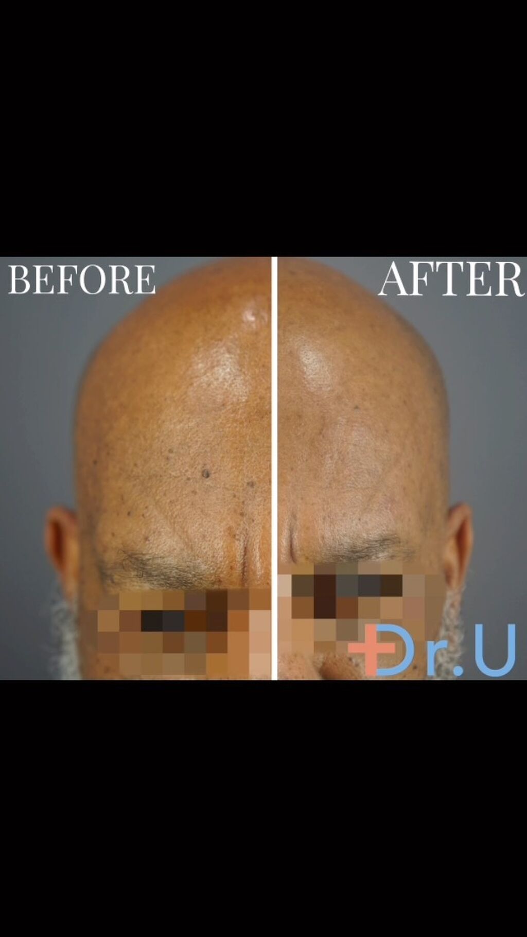 Dermatosis Papulosa Nigra (DPN)