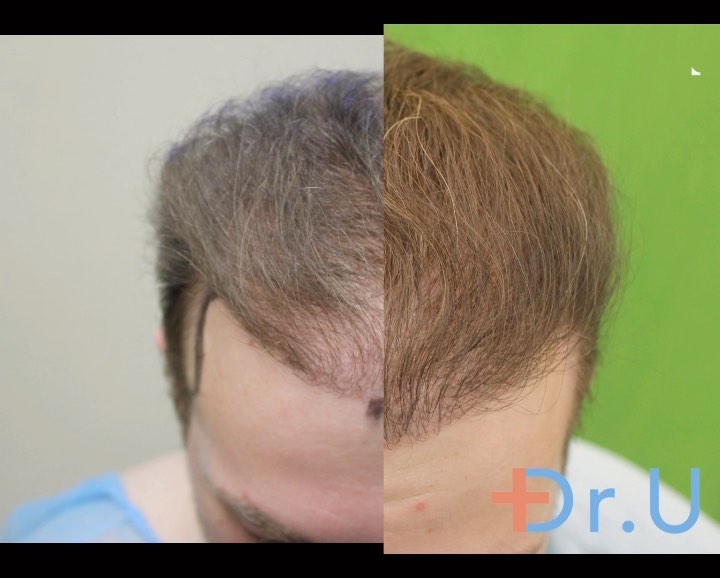 Dr. U Hair Surgery