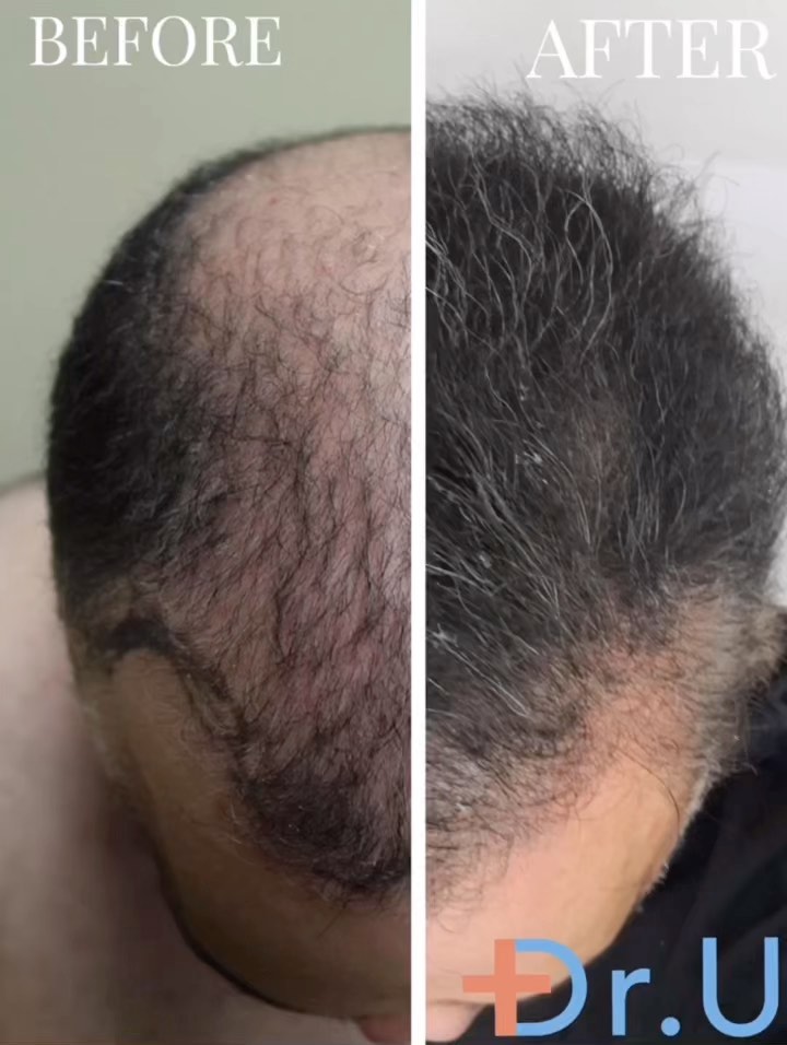 Dr. U Hair Surgery