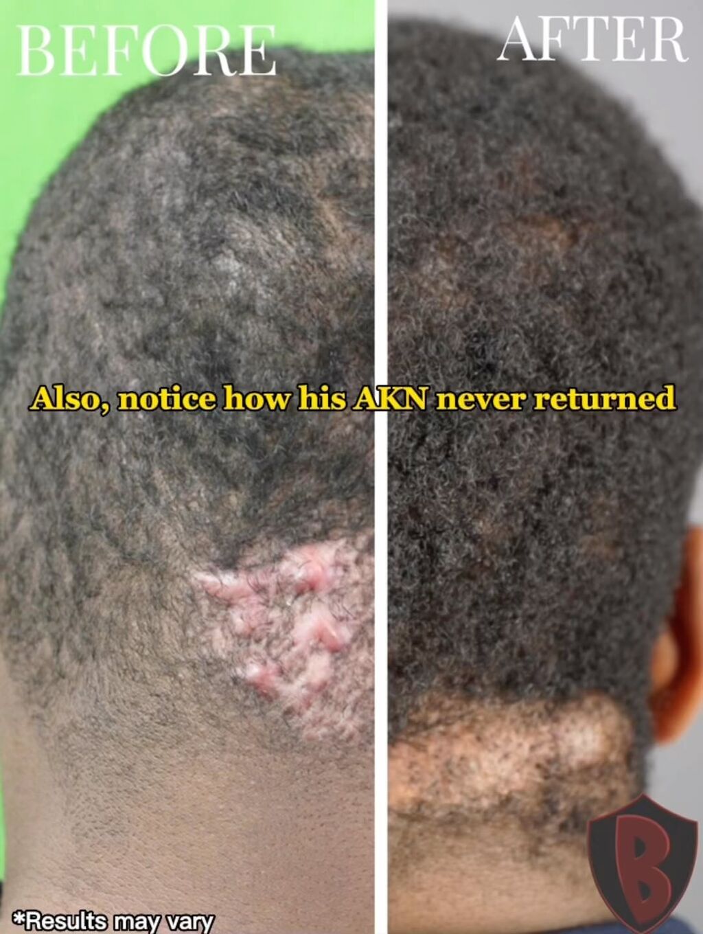 Dr. U Acne Keloidalis Nuchae 
