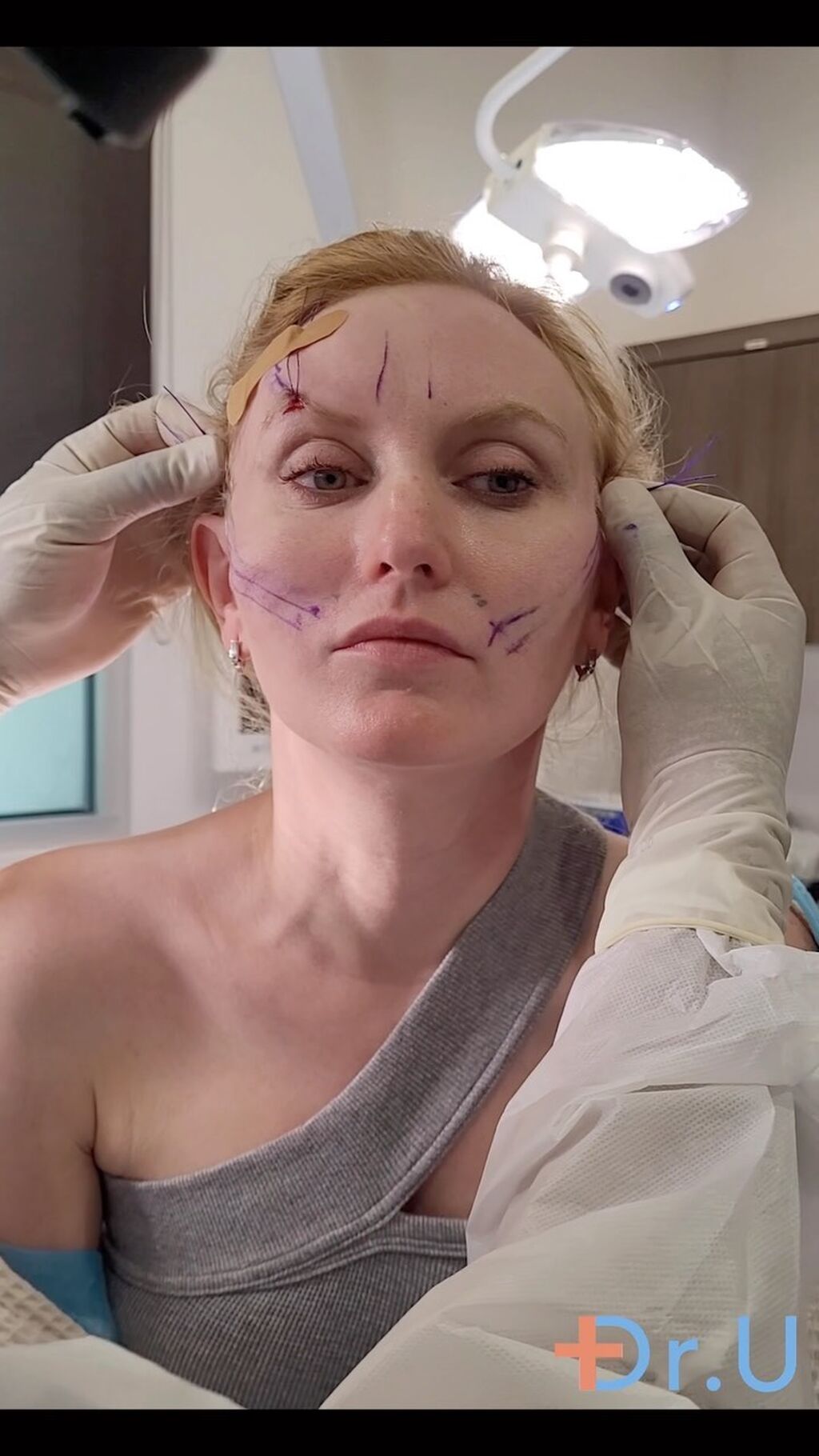 Non Surgical Jowl Lift