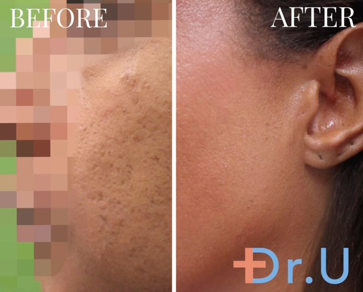 Acne Scar Treatment