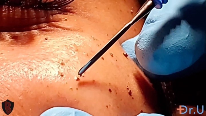 Dermatosis Papulosa Nigra