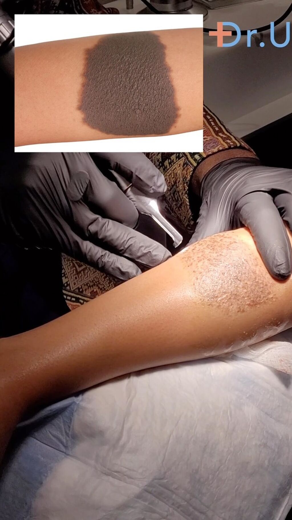 Dr. UGraft Body Hair Transplant Services
