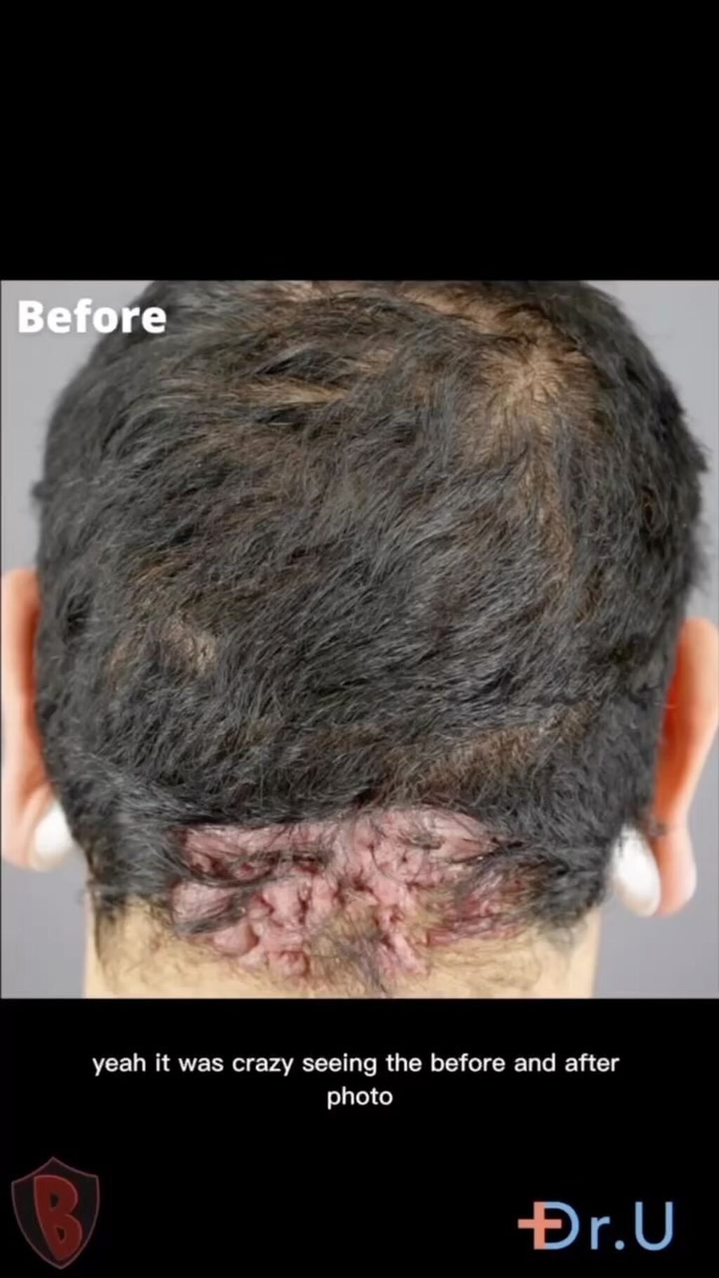 Acne Keloidalis Nuchae Treatment 
