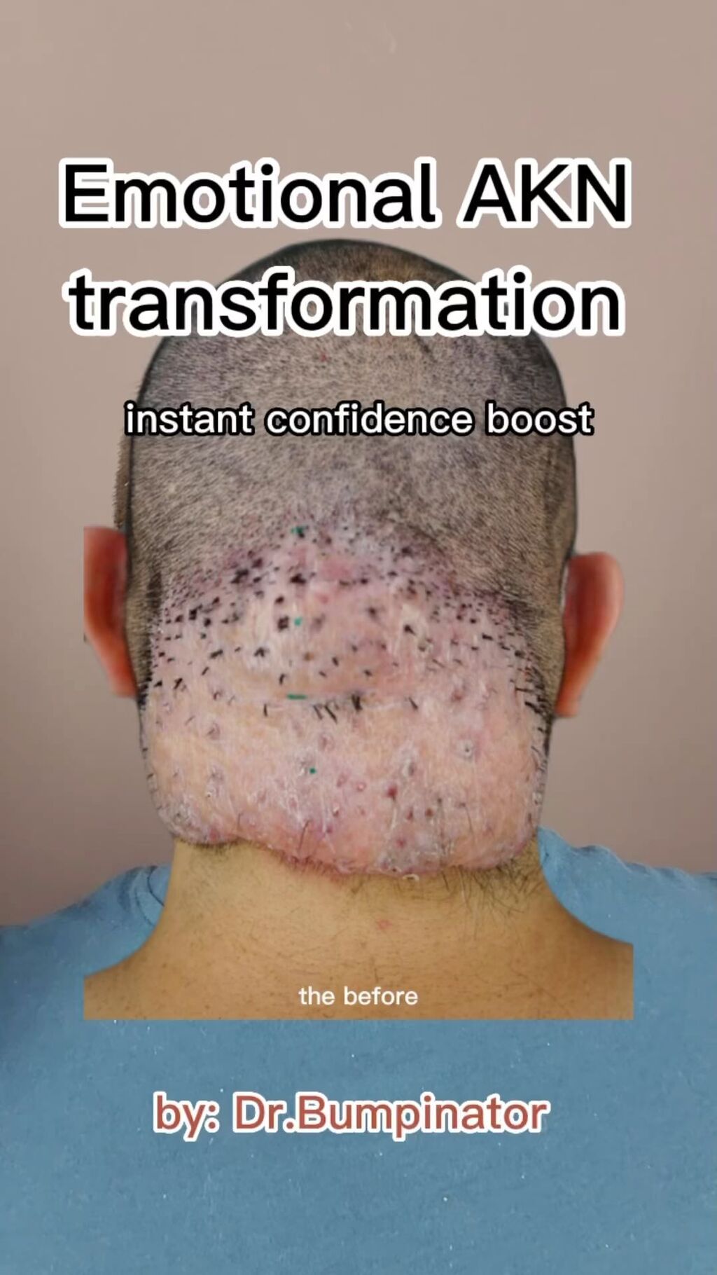 Acne Keloidalis Nuchae Treatment 
