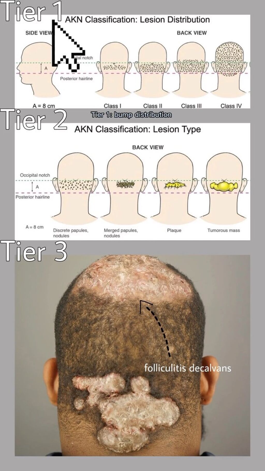 Dr. Bumpinator Entertains and Educates, Bringing Public Awareness to Acne Keloidalis Nuchae