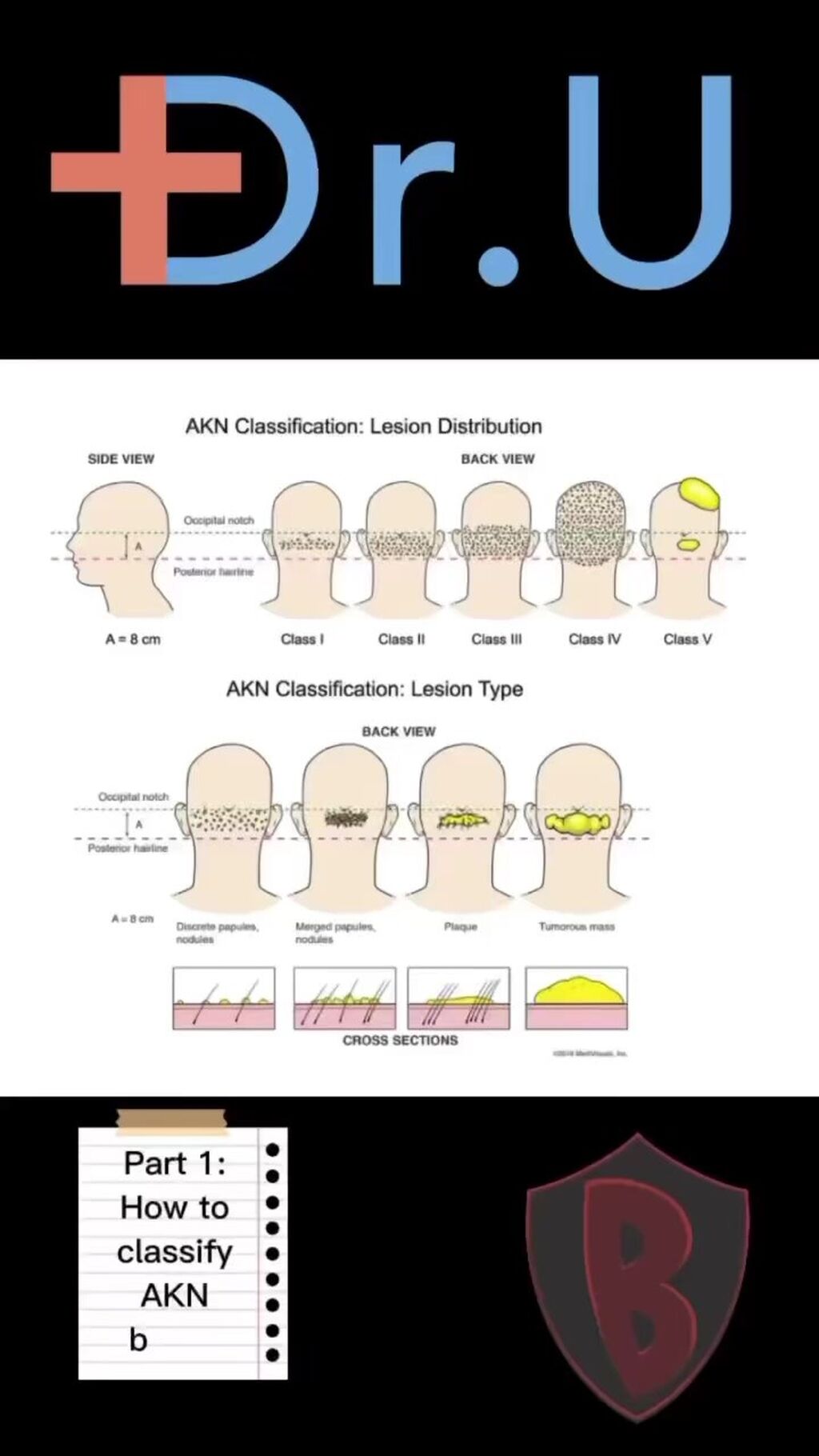 Why Acne Keloidalis Nuchae Classification Leads to Better Treatment Results