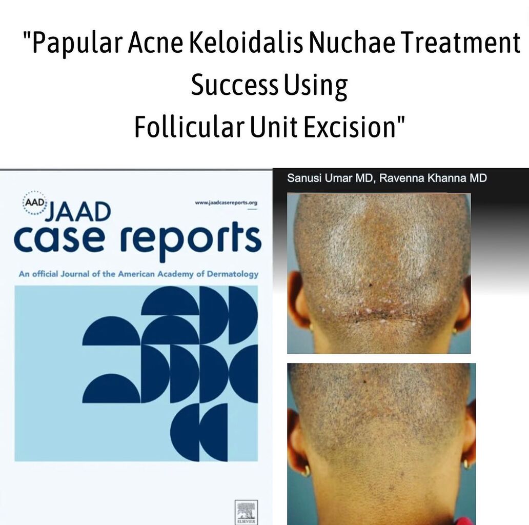 Papular acne keloidalis nuchae treatment success using follicular unit excision