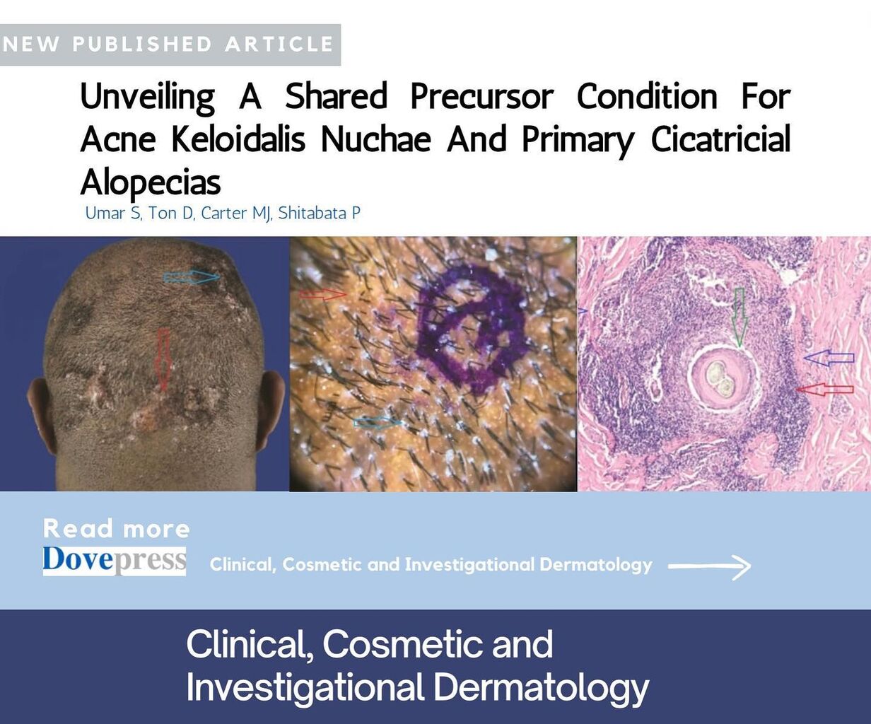 Unveiling a Shared Precursor Condition for Acne Keloidalis Nuchae and Primary Cicatricial Alopecias