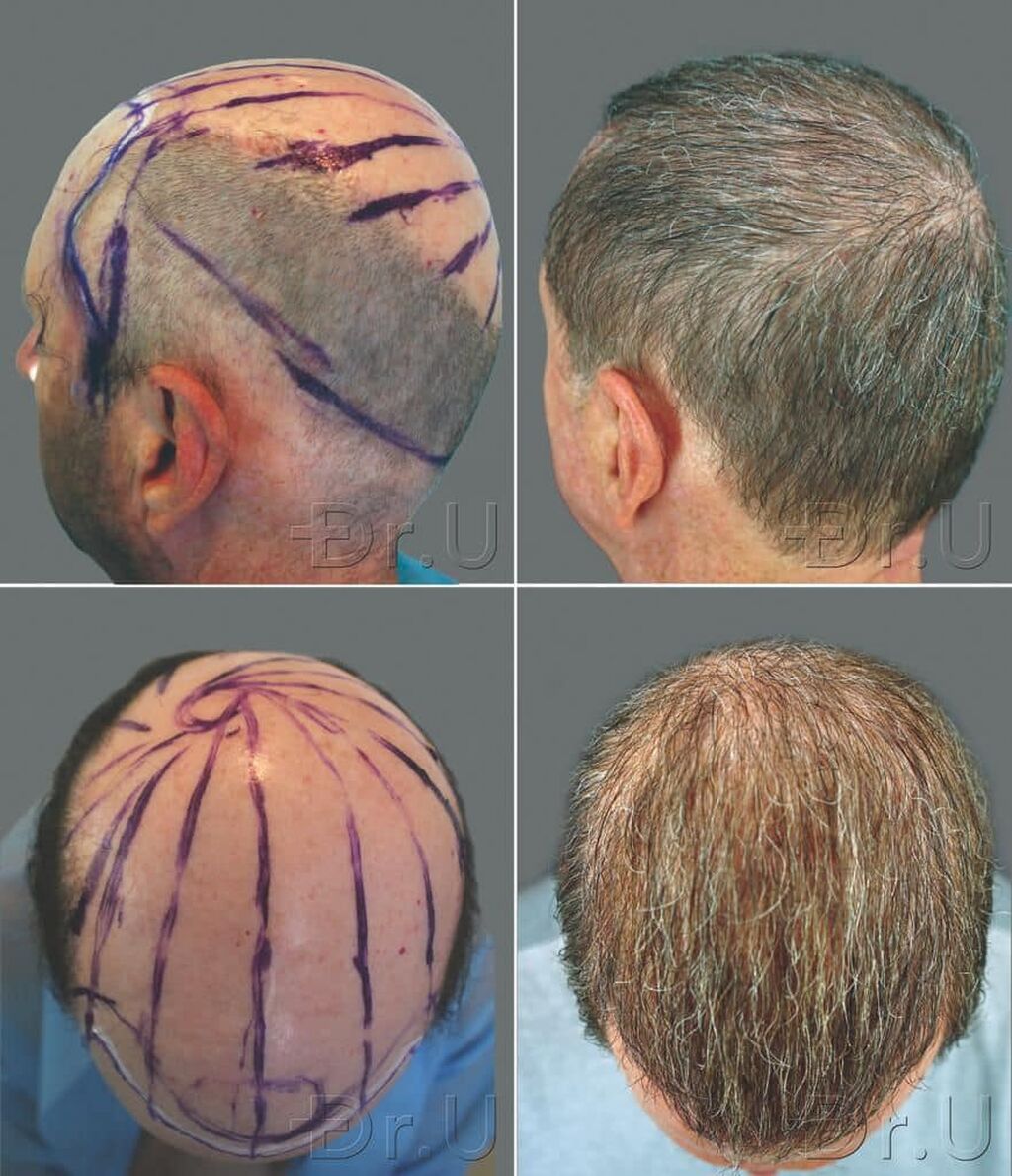 Rethinking the Impossible For Severe Baldness Worse Than Norwood 7