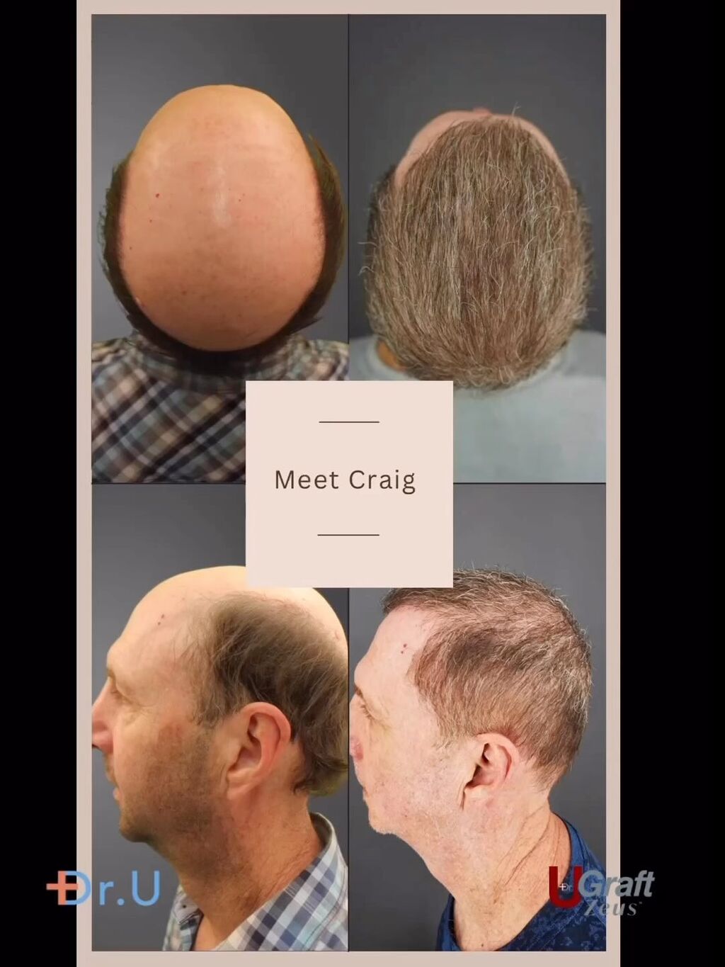 Rethinking the Impossible For Severe Baldness Worse Than Norwood 7