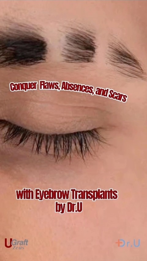Dr. UGraft Eyebrow Hair Transplant Services