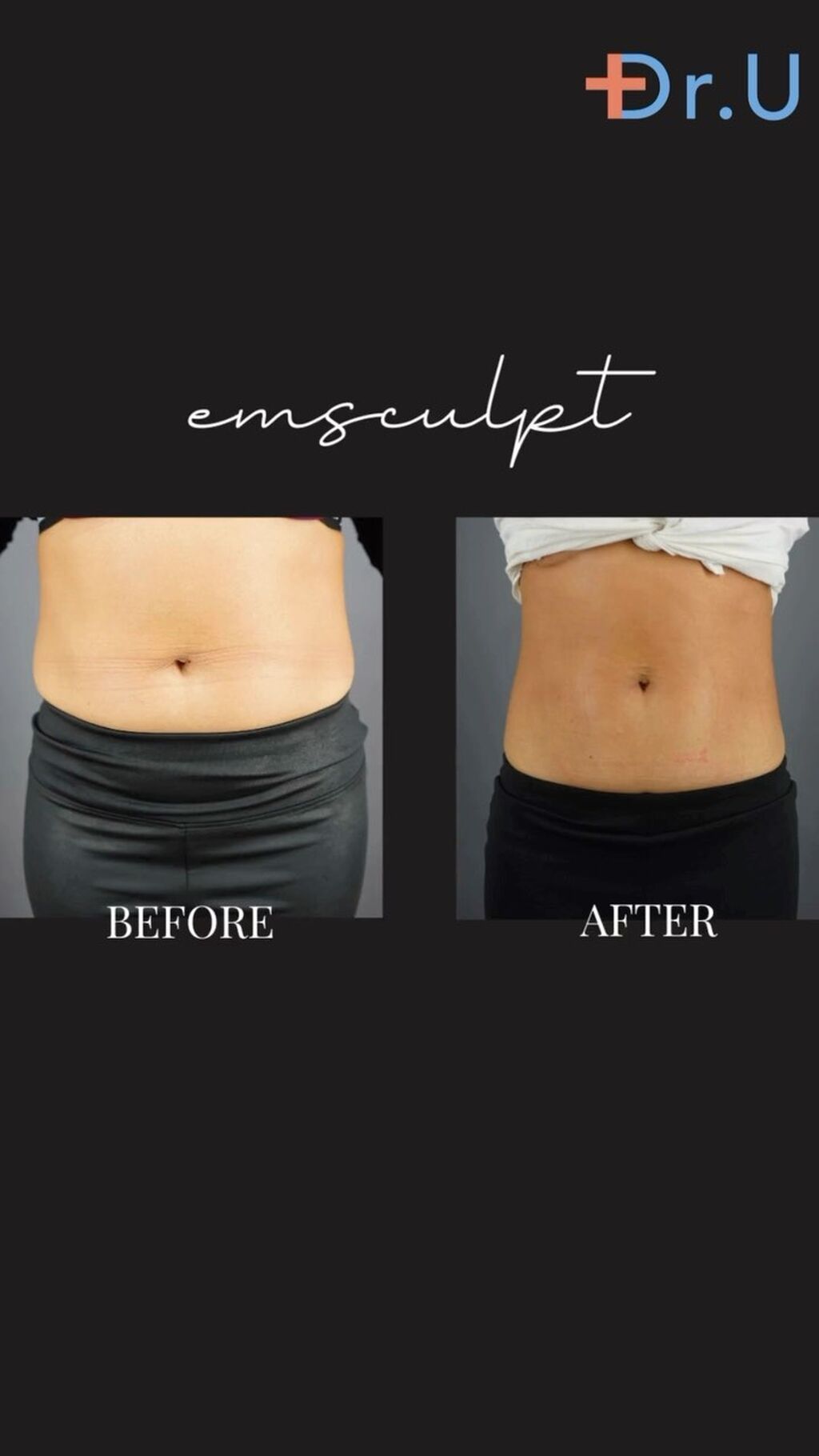 BTL EMSCULPT Muscle Toning and Sculpting