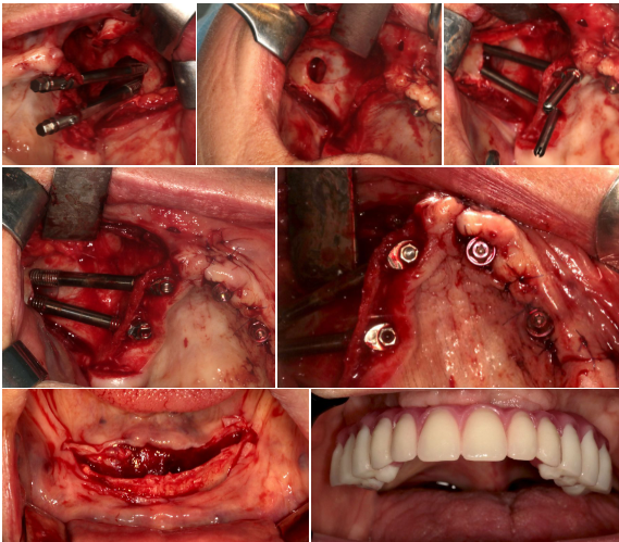 Bimaxillary case by Dr Sepehr Zarrine 