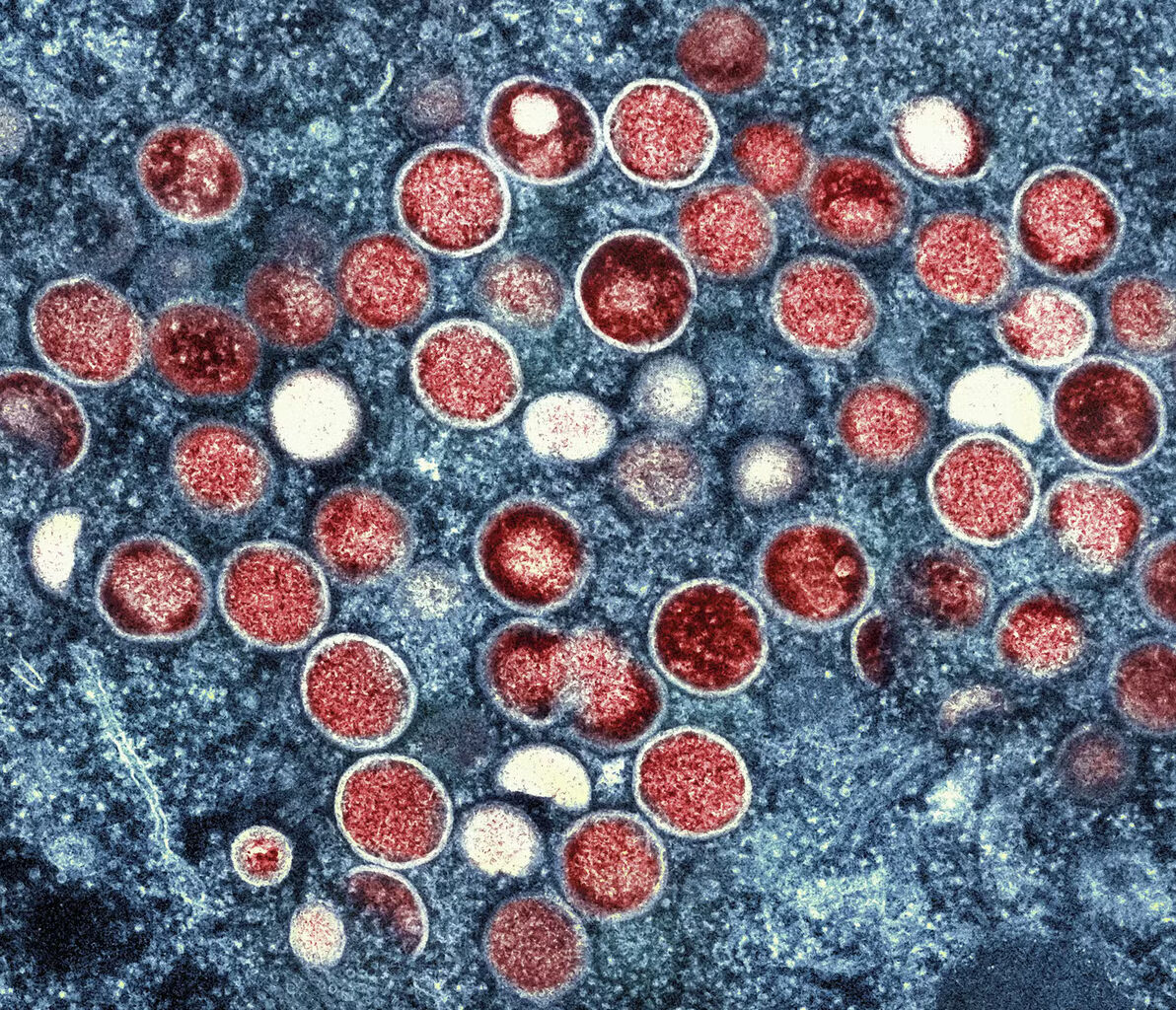 Mpox signs and symptoms