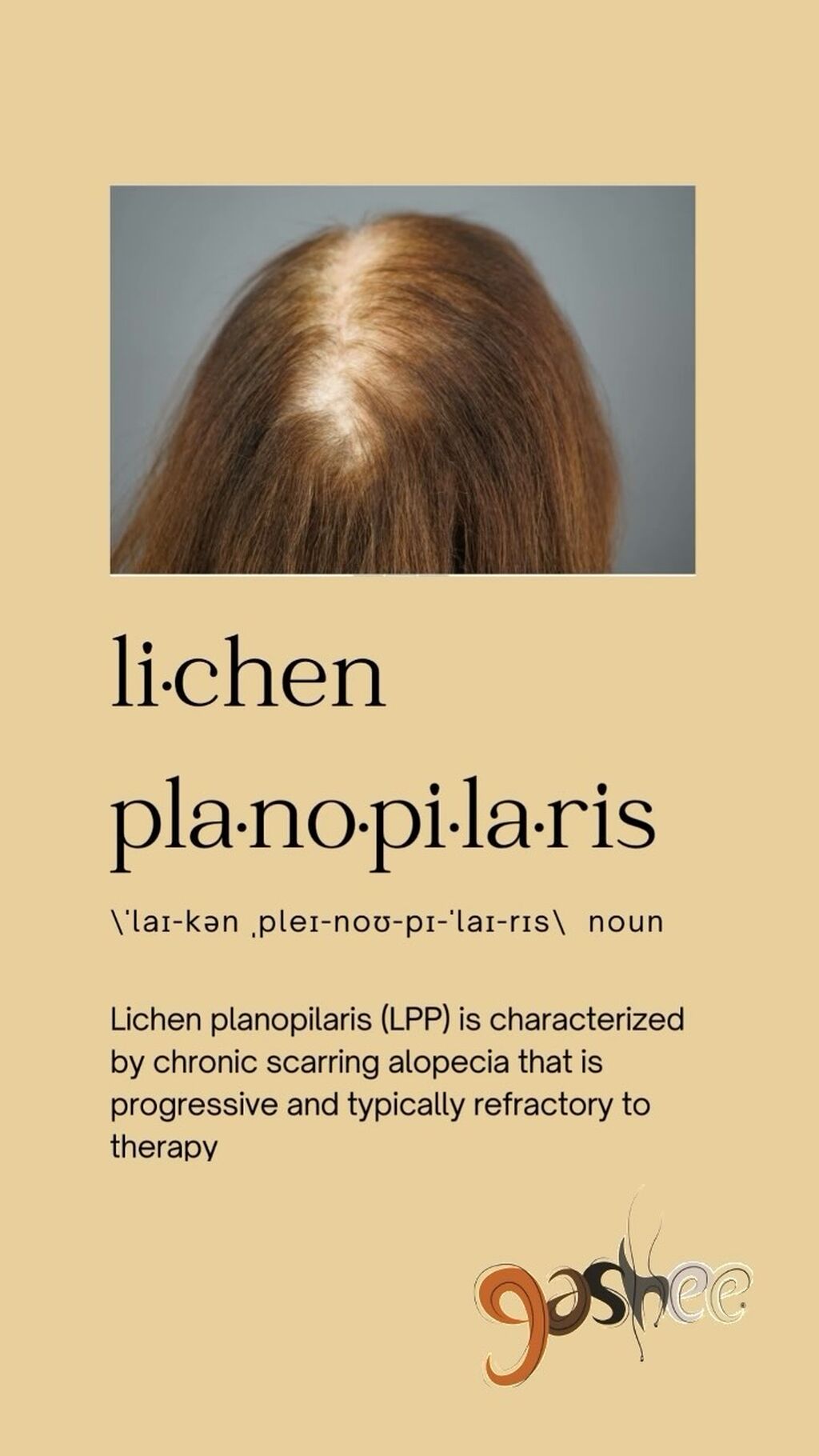 Lichen Planopilaris Responsive to a Novel Phytoactive Botanical Treatment: A Case Series