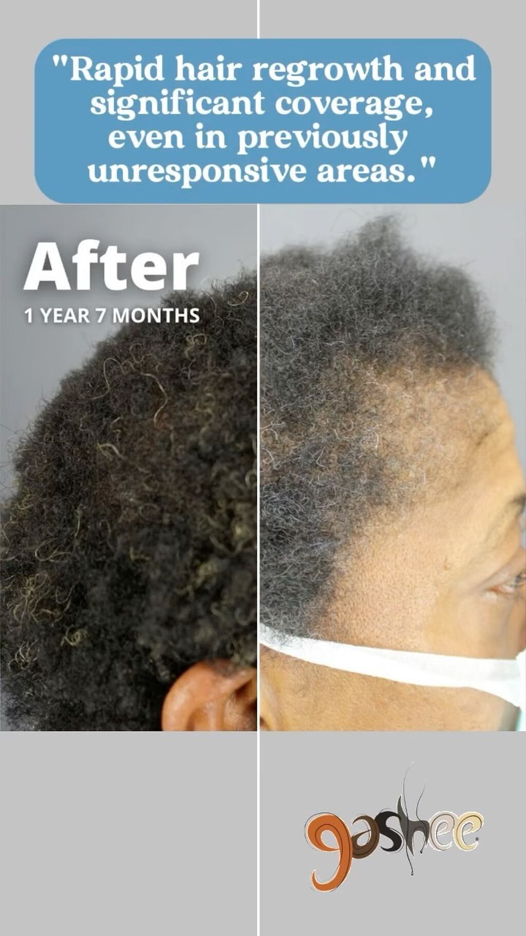 Treatment-Refractory Central Centrifugal Cicatricial Alopecia Responsive to a Novel Botanical Treatment
