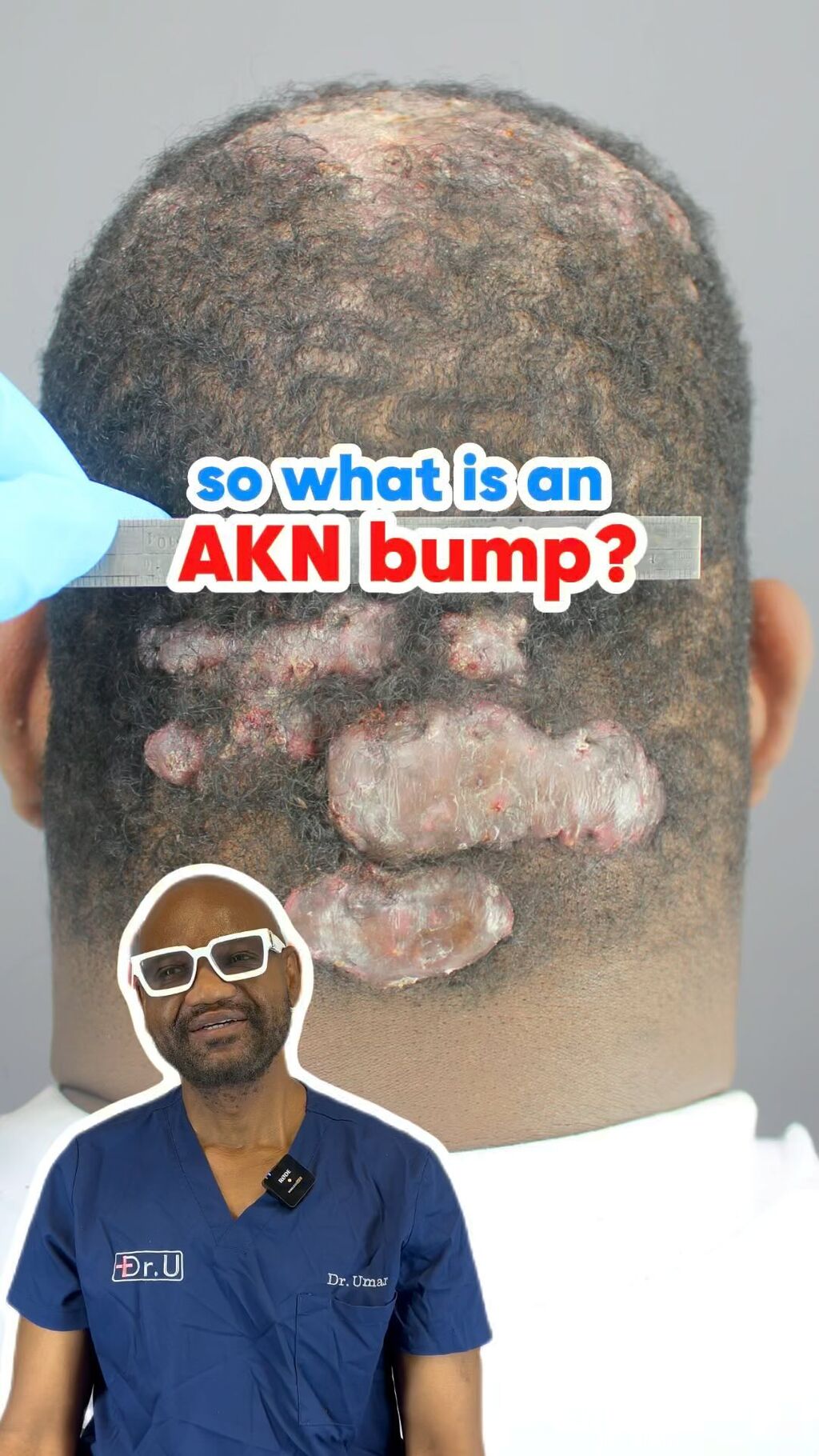 What is Acne Keloidalis Nuchae or AKN?