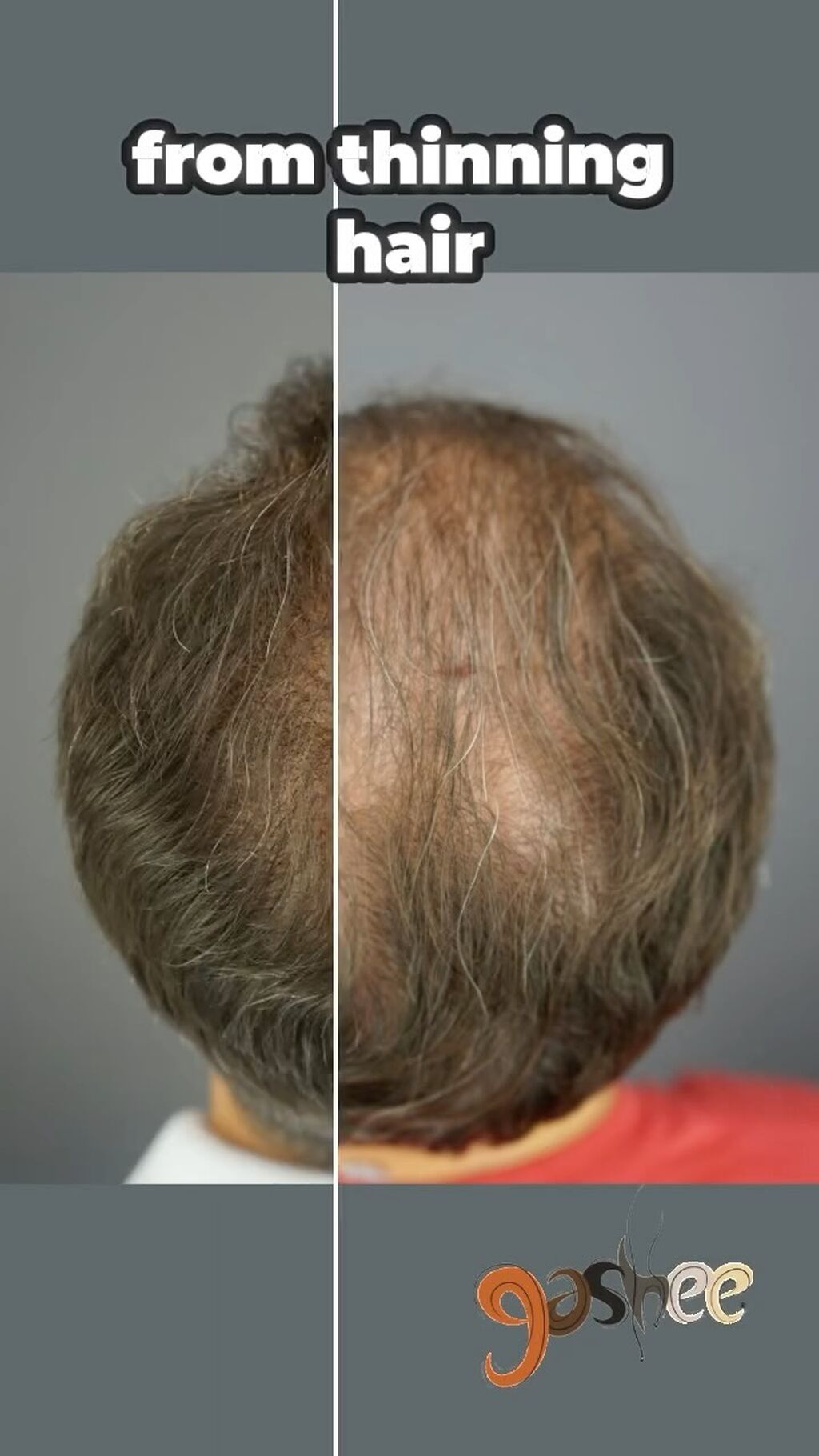 GASHEE Hair Stories: Stop Men&rsquo;s Hair Loss with GASHEE