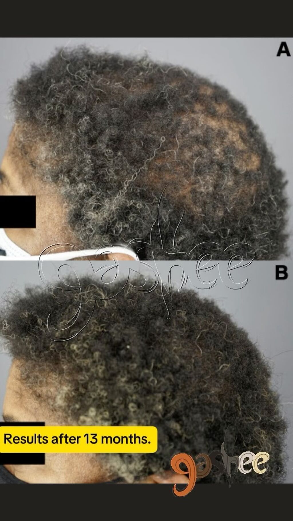 GASHEE Hair Stories: Kathleen&rsquo;s Journey to Overcome CCCA with GASHEE Products