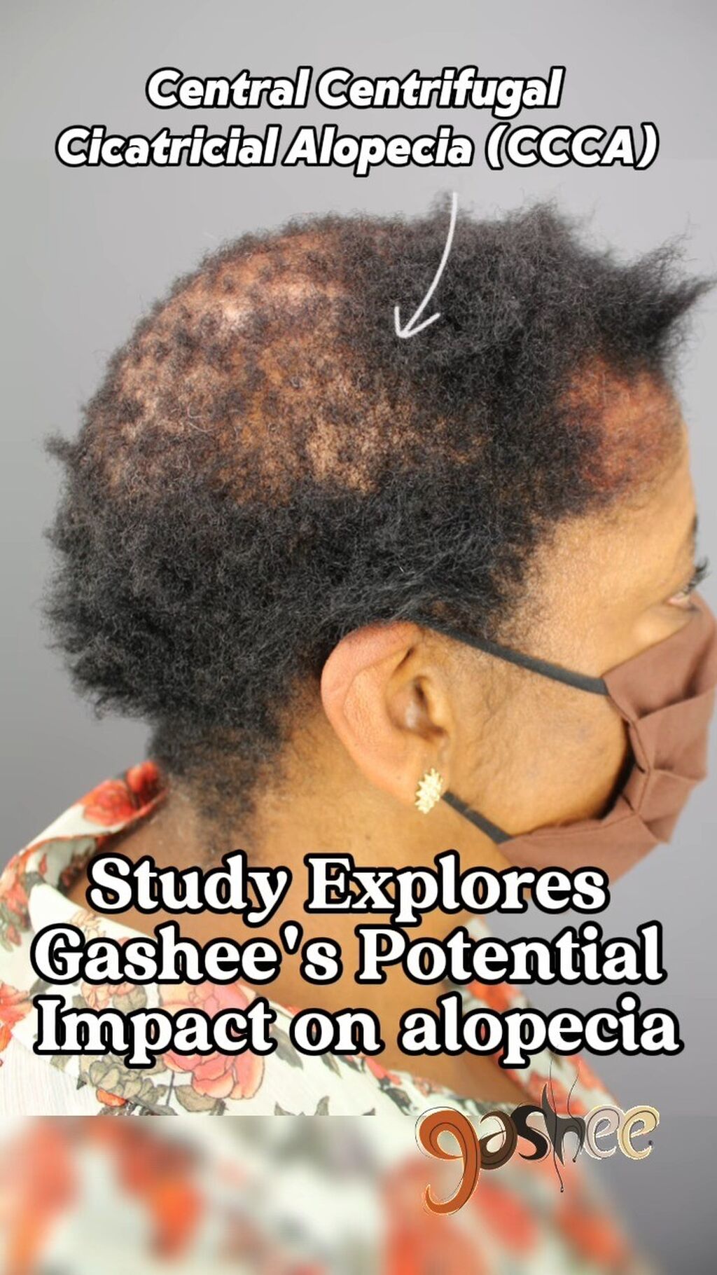 GASHEE Hair Stories: Kathleen&rsquo;s Journey to Overcome CCCA with GASHEE Products