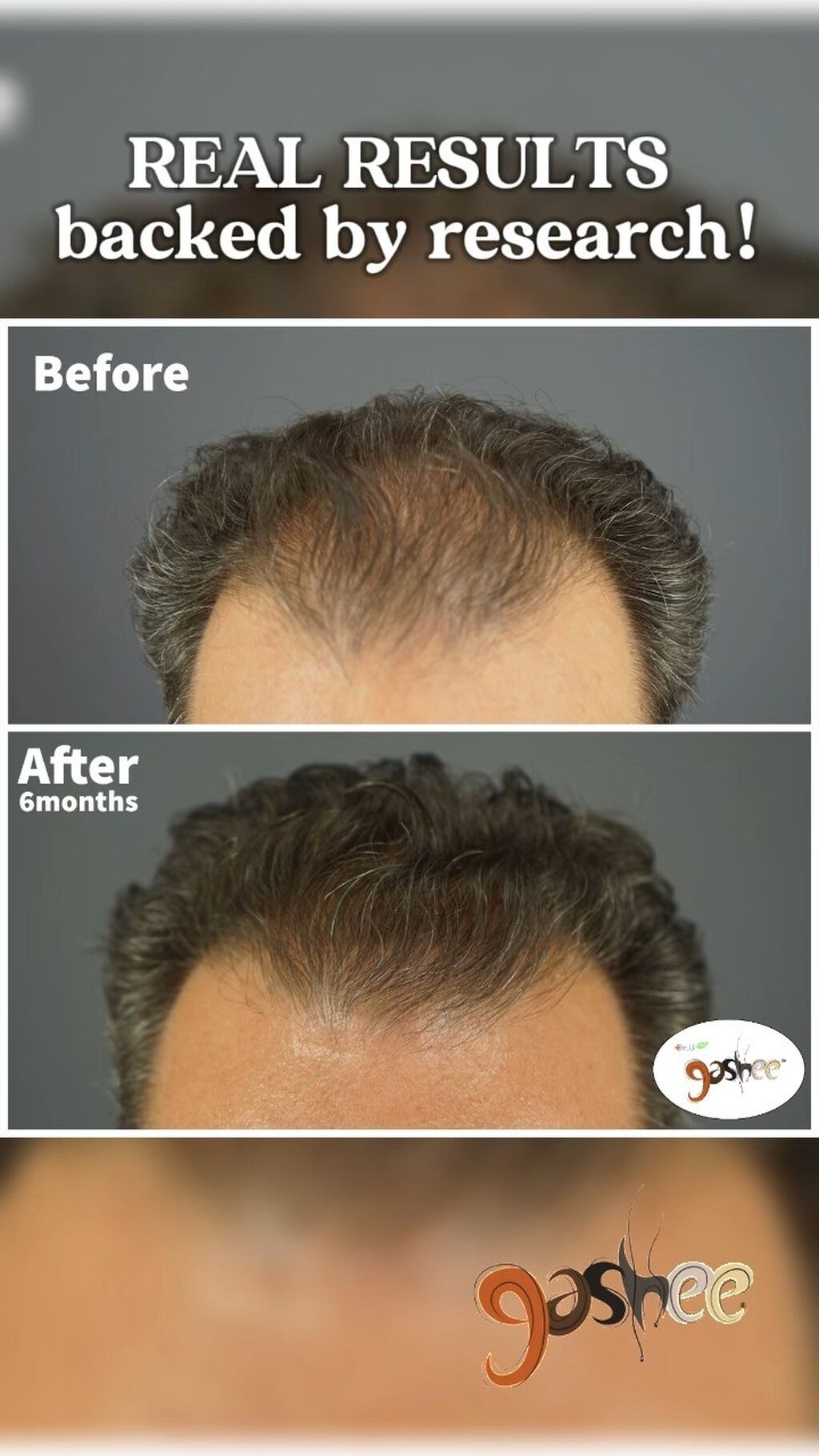 GASHEE Hair Stories: Stop Men&rsquo;s Hair Loss with GASHEE