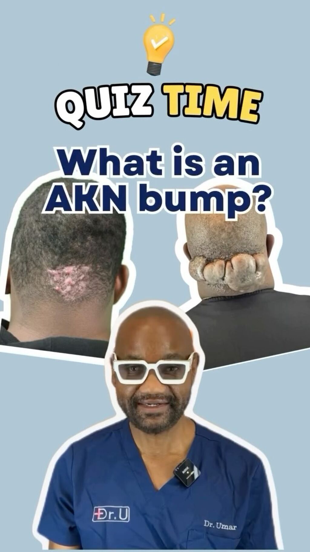What is Acne Keloidalis Nuchae or AKN?