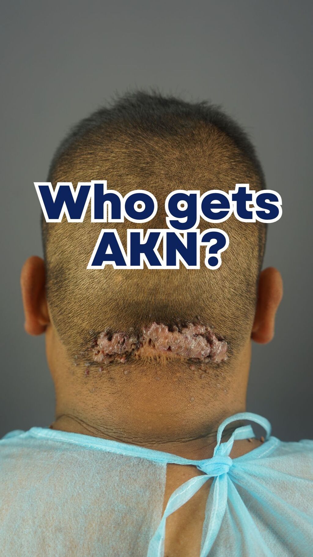 What is Acne Keloidalis Nuchae or AKN?