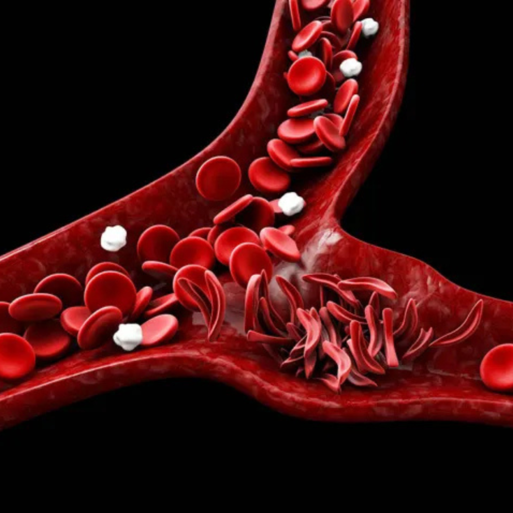 Tracking Sickle Cell Symptoms With Infrared Light