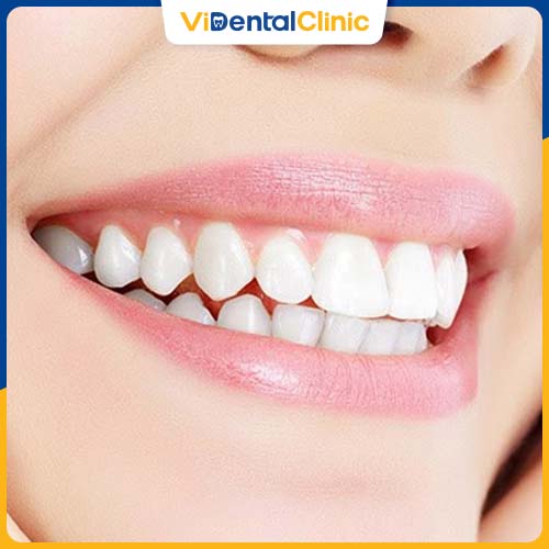 Trồng Răng Emax: Lựa Chọn Ho&agrave;n Hảo Cho Phục H&igrave;nh Răng