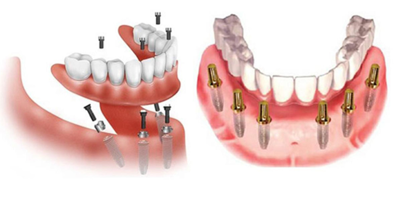 Trồng Răng H&agrave;m Dưới: Giải Ph&aacute;p Ho&agrave;n Hảo Cho Nụ Cười Tự Tin