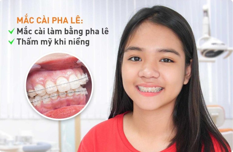Bảng Gi&aacute; Niềng Răng Mắc C&agrave;i Pha L&ecirc; Mới Nhất Hiện Nay