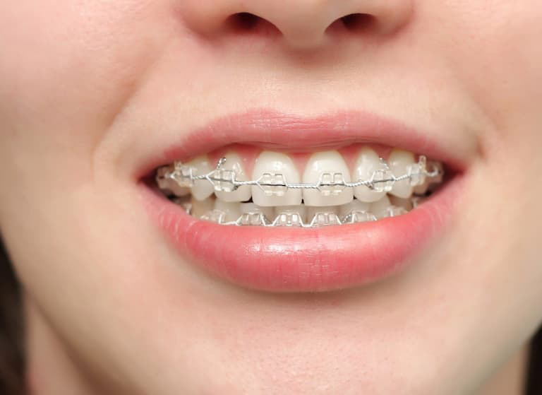 Niềng Răng Bị Sưng Lợi: Biểu Hiện v&agrave; C&aacute;c Giải Ph&aacute;p Xử L&yacute;