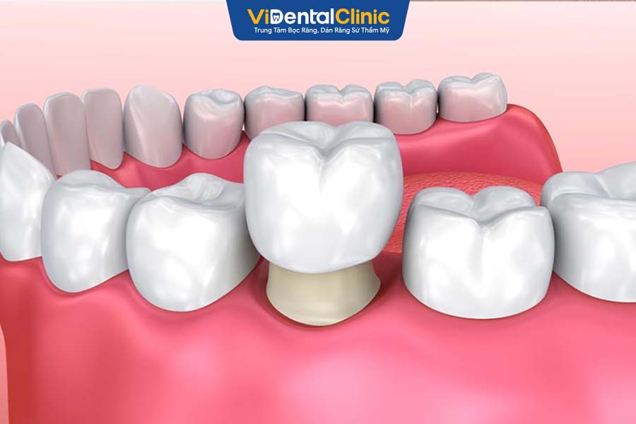 C&aacute;ch Trồng Răng Sứ: Quy Tr&igrave;nh Chi Ph&iacute; v&agrave; Những Điều Cần Lưu &Yacute;