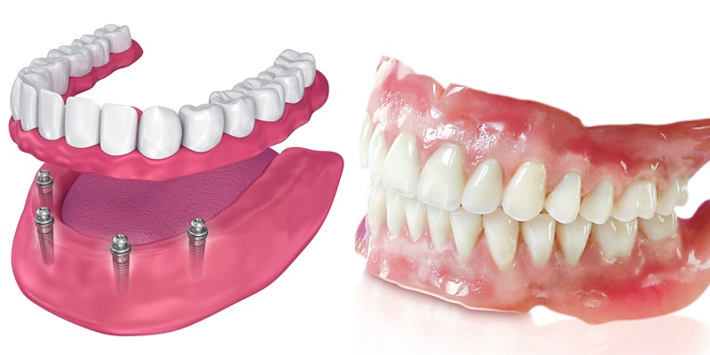 Trồng Răng Cho Người Gi&agrave;: Giải Ph&aacute;p Phục Hồi Chức Năng V&agrave; Nụ Cười Tự Tin