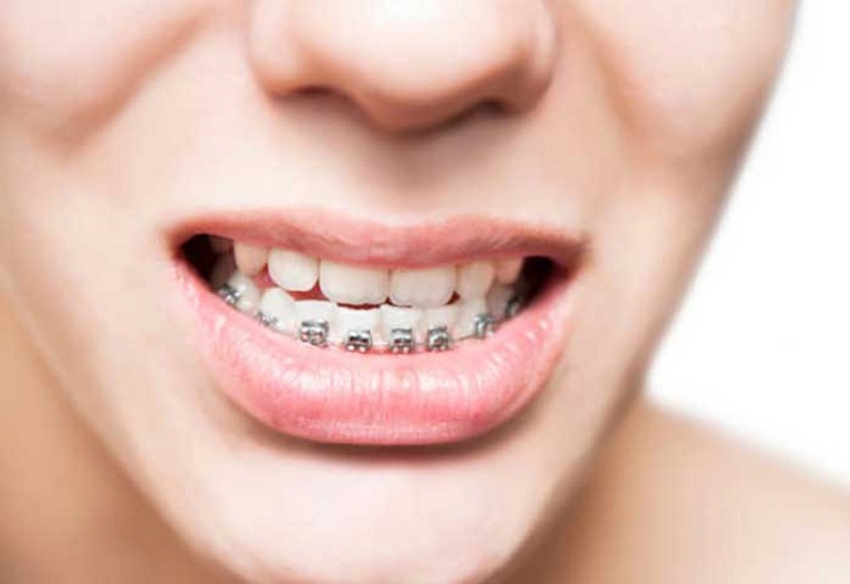 Niềng răng m&oacute;m bao nhi&ecirc;u tiền chọn phương ph&aacute;p n&agrave;o tốt nhất?