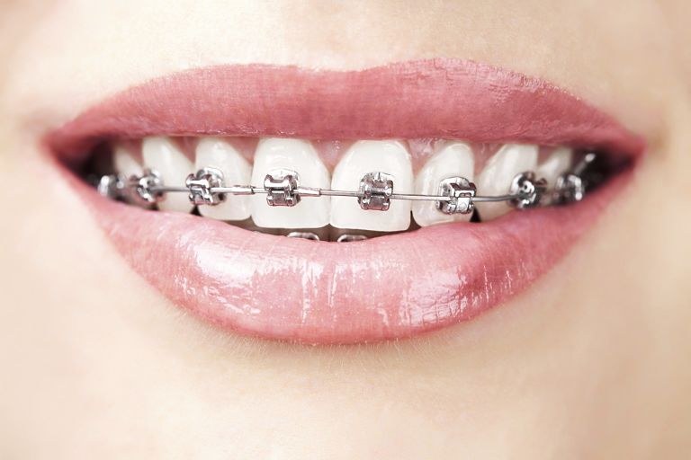Niềng răng mắc c&agrave;i kim loại l&agrave; g&igrave;? Một số th&ocirc;ng tin bạn cần biết