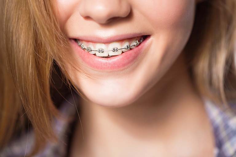 Niềng Răng C&oacute; Mấy Loại Quy Tr&igrave;nh L&agrave;m Chi Ph&iacute; Bao Nhi&ecirc;u?