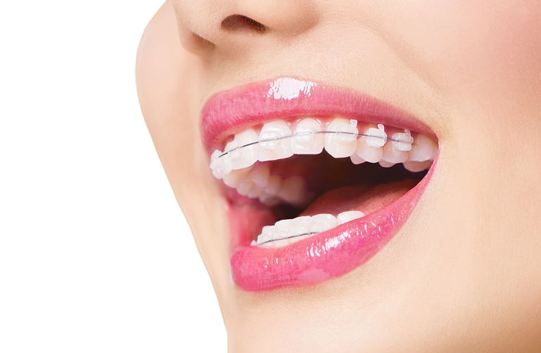 Gi&aacute; Niềng Răng Mắc C&agrave;i Sứ Bao Nhi&ecirc;u Th&ocirc;ng Tin Mới Nhất