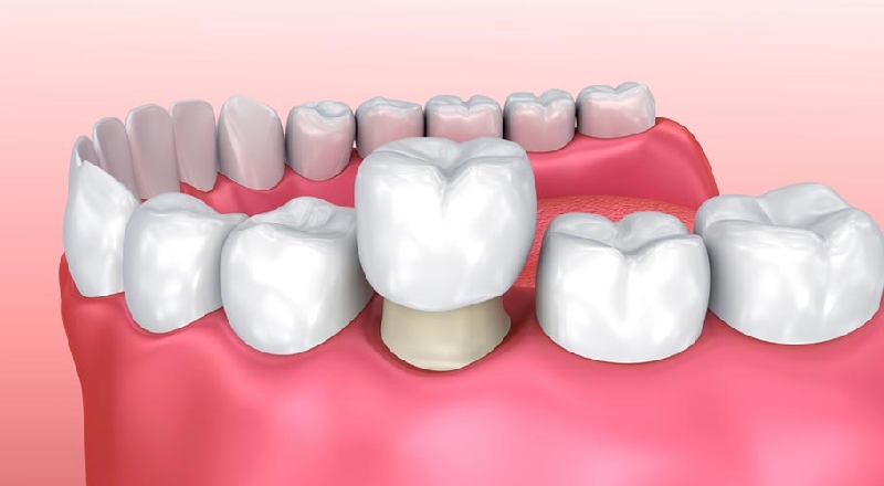 Nhổ Răng Số 7 Bao L&acirc;u Th&igrave; Trồng Lại Được? Thời Gian Quy Tr&igrave;nh V&agrave; Lưu &Yacute;